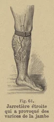 Tight garter causing varicose veins in the leg